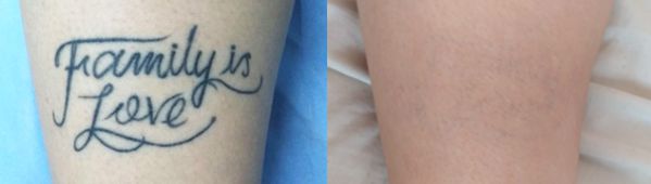 Antes y después borrado tatuaje